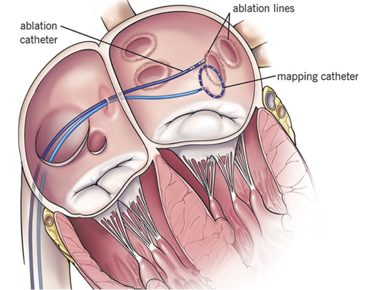 Endocardial ablation